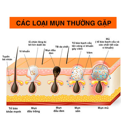 Điều Trị Mụn