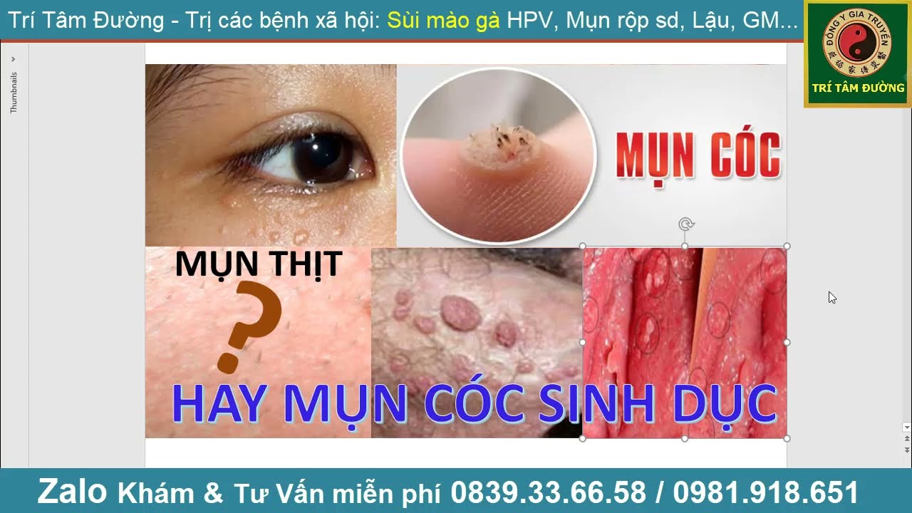 Mụn Cóc Tìm Hiểu Về Nguyên Nhân, Triệu Chứng và Cách Điều Trị