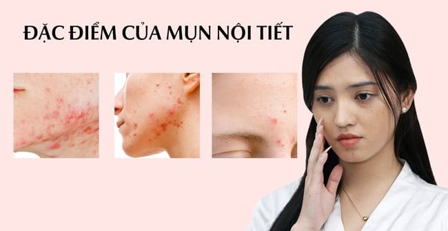 Điều trị mụn nội tiết hà nội