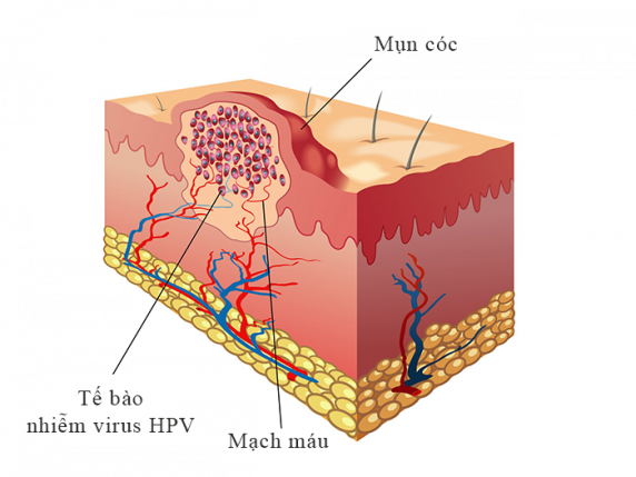 Điều Trị Mụn Hiệu Quả Tại Bắc Kạn