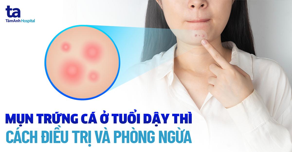 Điều trị mụn hiệu quả tại Bình Định