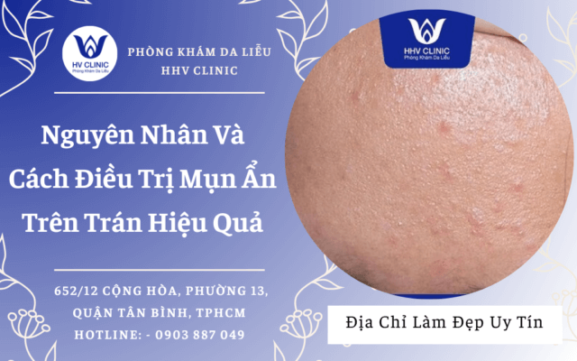 Điều trị mụn hiệu quả tại Bình Dương