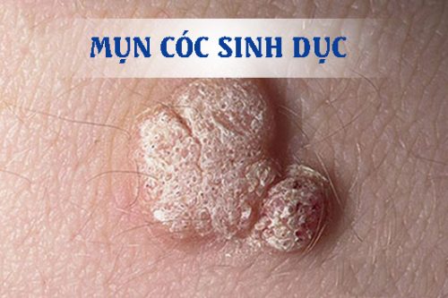 điều trị mụn cóc