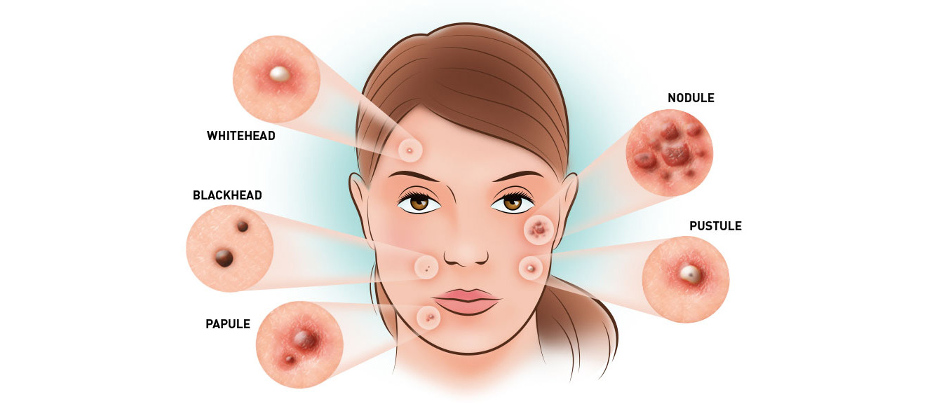 Điều trị mụn tại Gia Lai