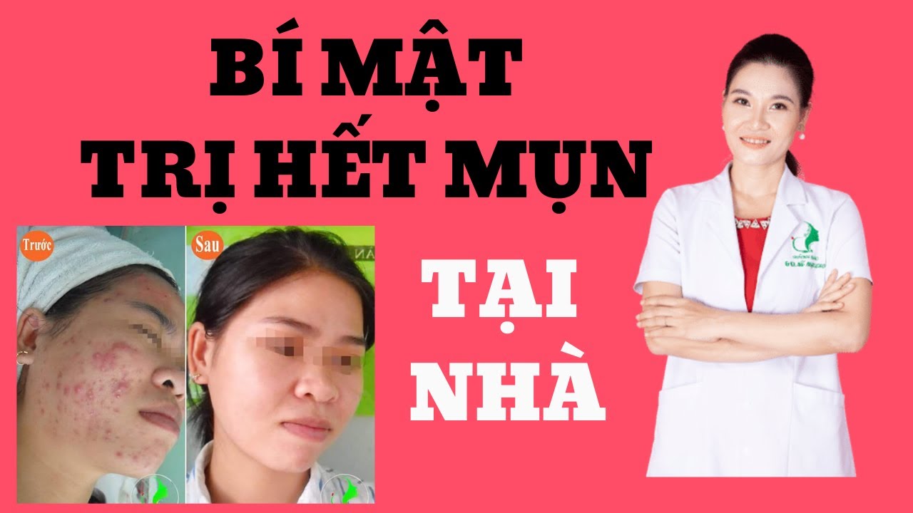 Điều trị mụn hiệu quả tại Sơn La