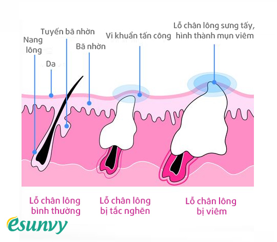 Điều trị mụn viêm hà nội