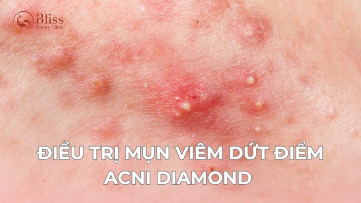 Điều trị mụn viêm hà nội