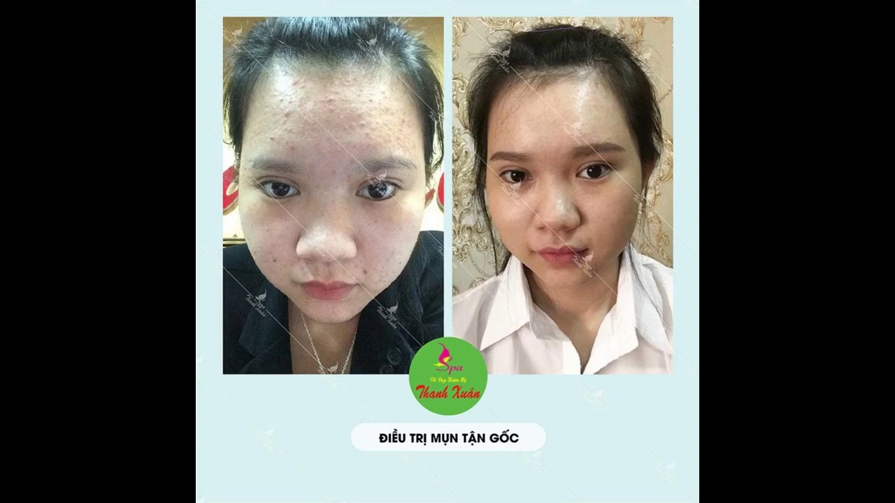 Thuốc Điều Trị Mụn Chuyên Cho Spa và TMV