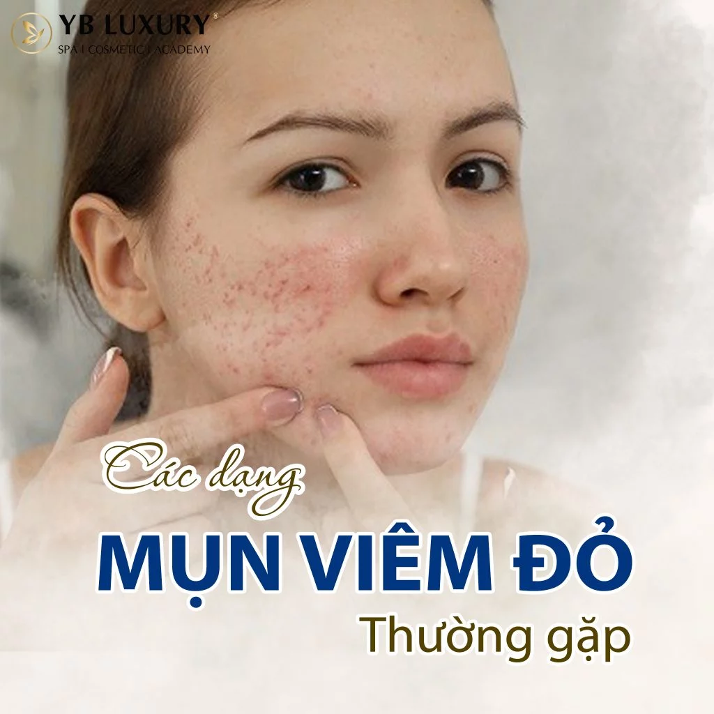 Trị mụn viêm Giải pháp hiệu quả cho làn da khỏe đẹp