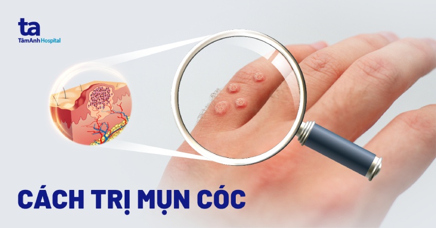 Cách Trị Mụn Cóc Ở Tay