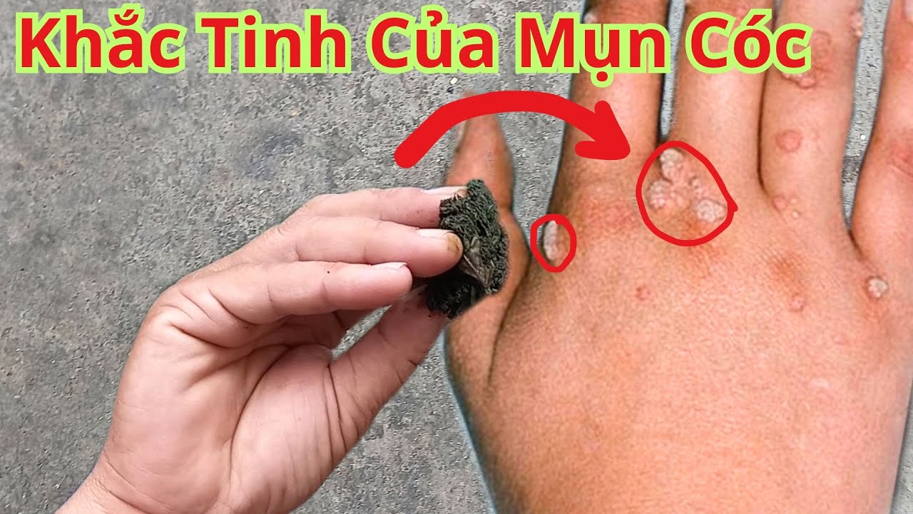 Cách Trị Mụn Cóc Ở Tay