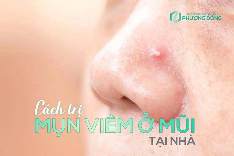 Cách Trị Mụn Viêm Hiệu Quả và Lâu Dài