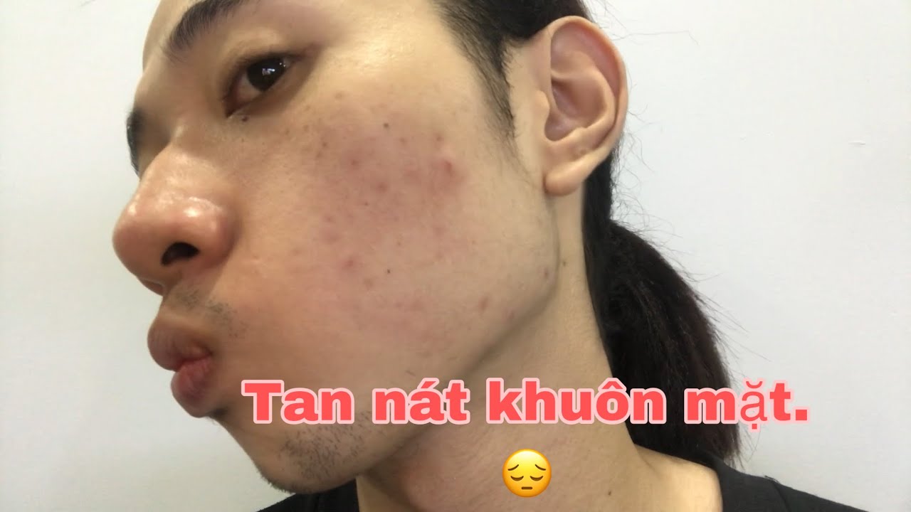 Điều Trị Mụn Hiệu Quả Tại Hasaki Giải Pháp Toàn Diện Cho Làn Da Sáng Mịn