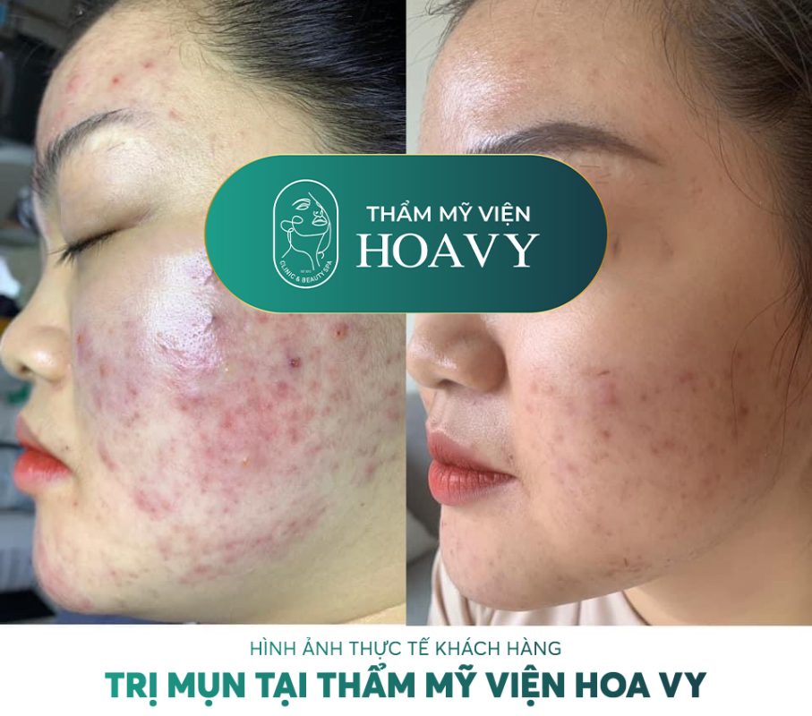 Điều Trị Mụn Hiệu Quả  Uy Tín Tại Hà Nội