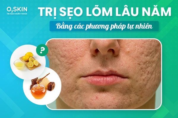 Khám Phá Giải Pháp Trị Sẹo Mụn Toàn Diện