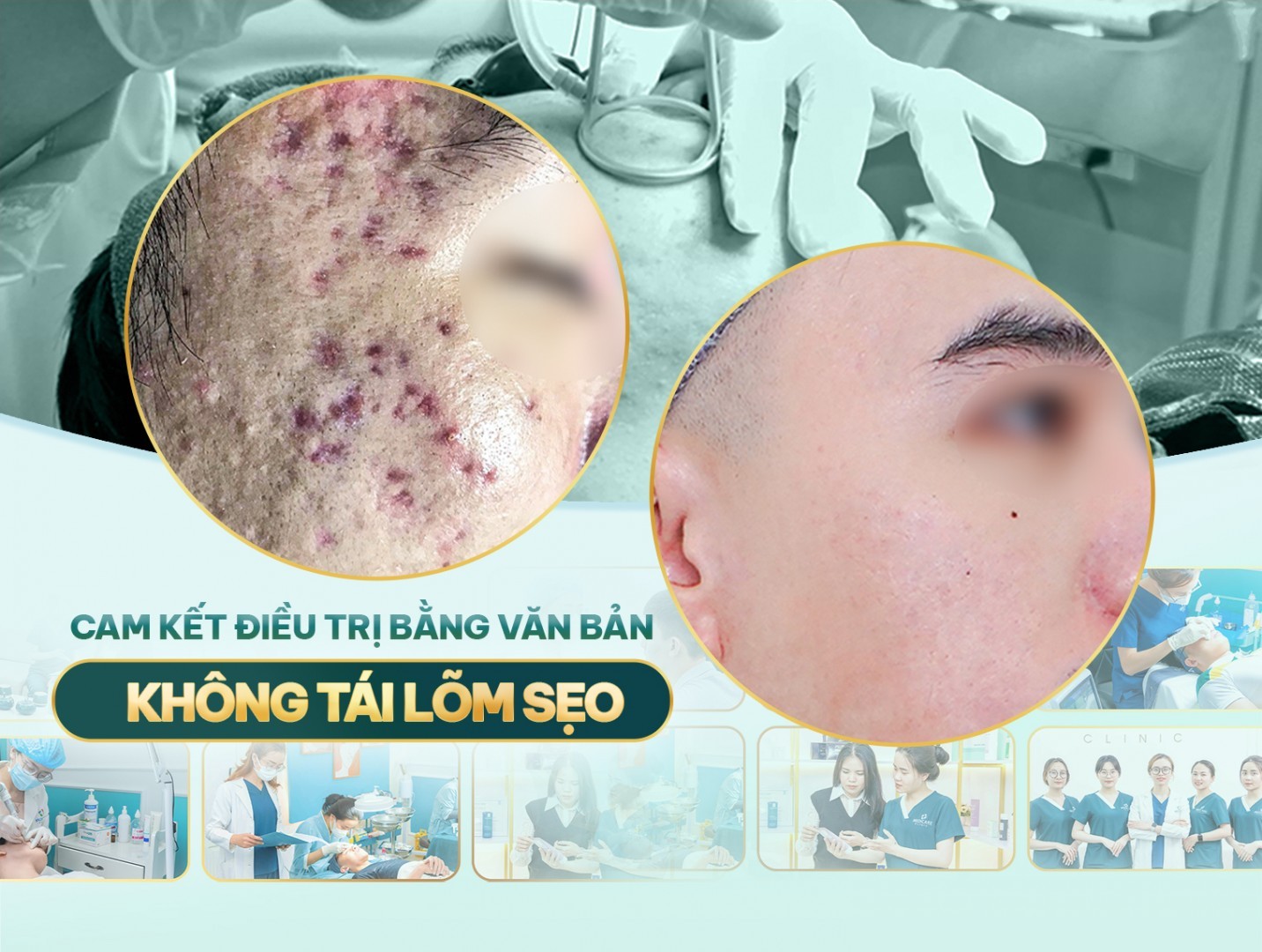 Trị mụn hết bao nhiêu tiền