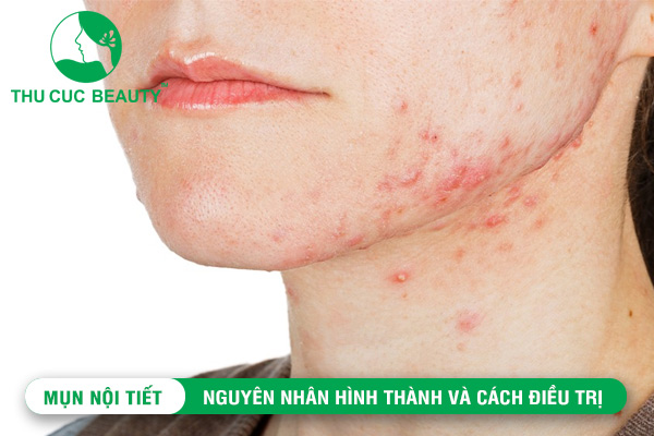 Trị Mụn Nội Tiết Hiểu rõ nguyên nhân và cách khắc phục hiệu quả